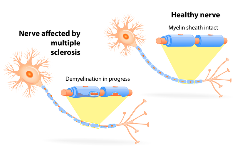 Illustration for article titled "Surprising" Breakthrough in Multiple Sclerosis Mouse Study